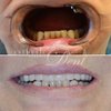 all-on-four восстановление жевательной функции зубов