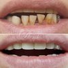 Восстановление эстетического вида зубов при протезировании Всё на четырех фото