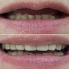 Восстановление зубов с использованием бюгельных протезов