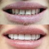Восстановления красоты зубов люминирами