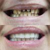 Восстановление улыбки коронками из циркония и люминирами