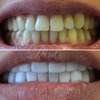 Люминиры для восстановления красоты зубов