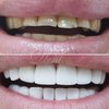 Использование люминиров в эстетической стоматологии