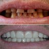 Красивая улыбка и здоровый вид зубов с помощью виниров фото