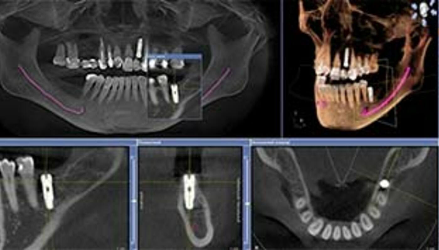 3д снимок челюсти. 3д снимок челюсти киста. Холестеатома челюстей рентген.