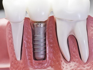 Восстановление удаленных зубов имплантами